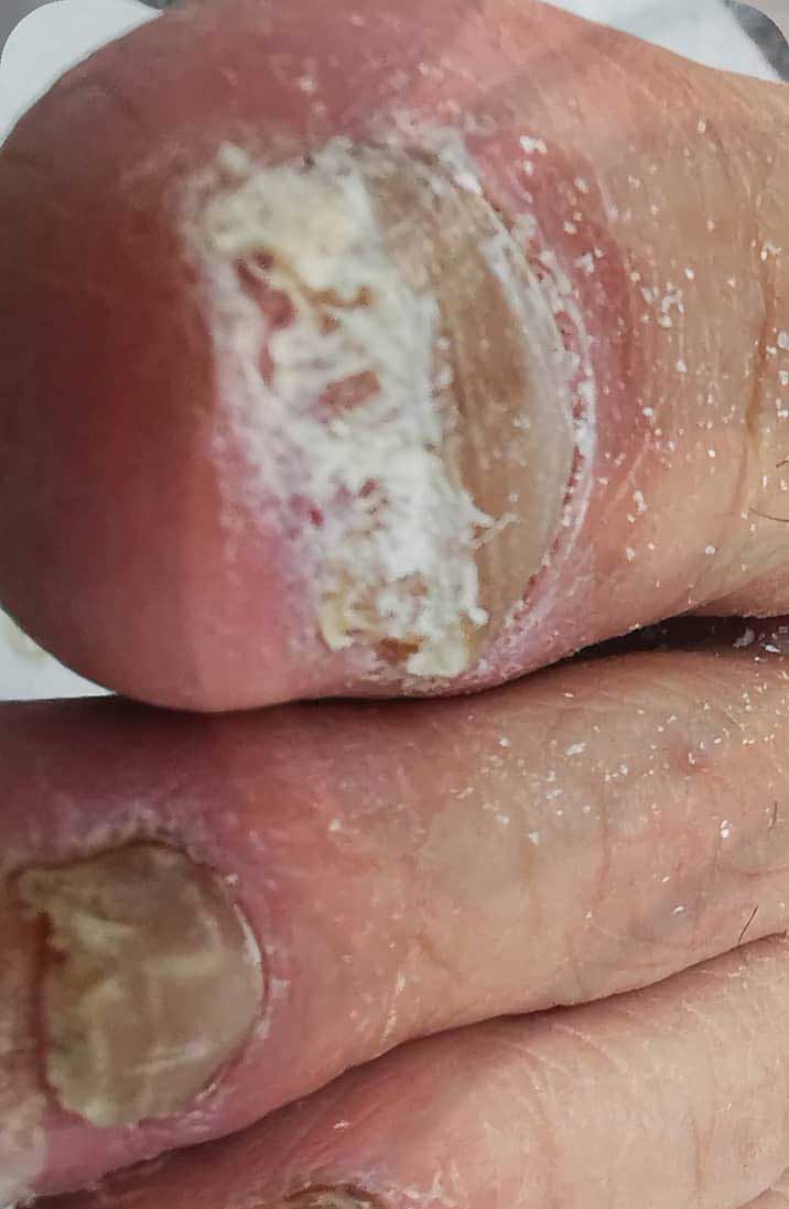 Vorher Nagelpilz am Fussnagel in Hanau