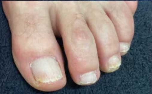 Nachher Nagelpilz Kontrolle in Hanau