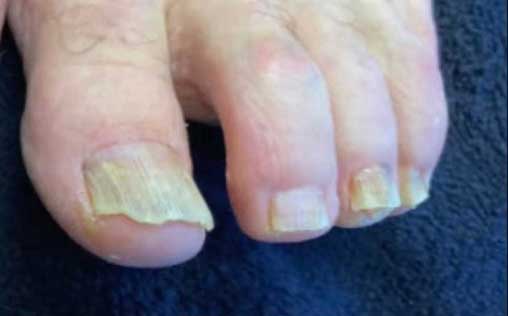 Vorher Nagelpilz Kontrolle in Hanau