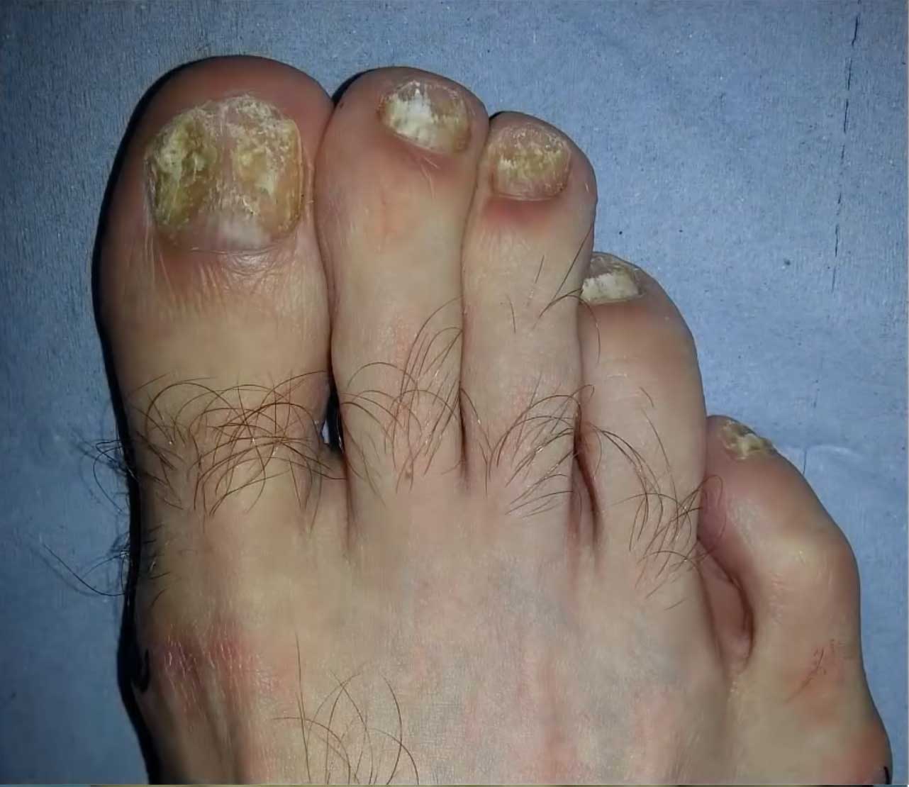 Vorher Onychomykose Nagelpilz Behandlung Hanau