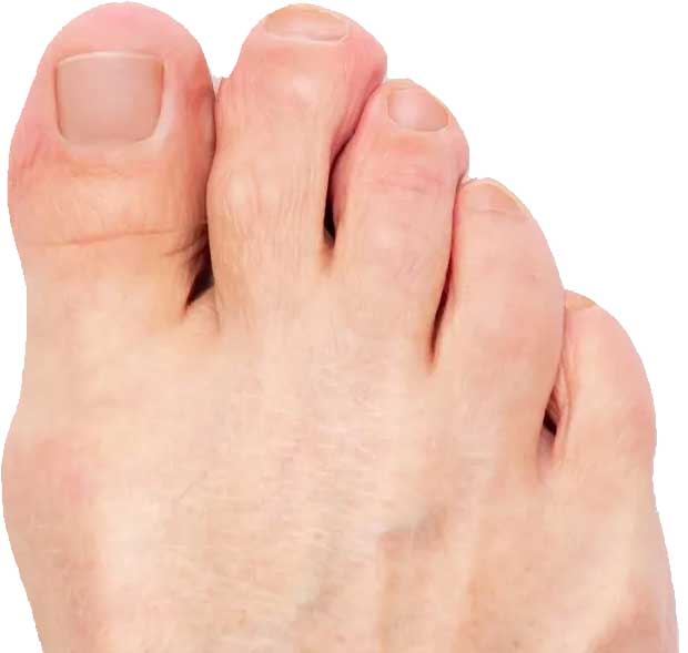 Nachher Nagelpilz Therapie in Hanau