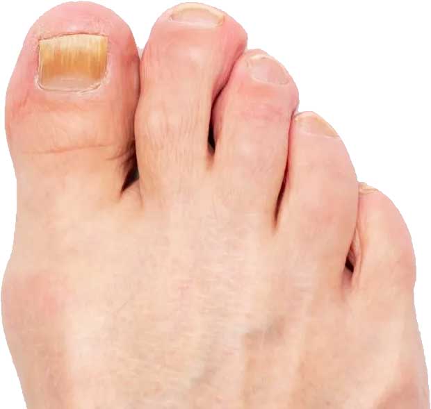 Vorher Nagelpilz Therapie in Hanau