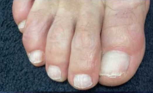 Nachher Nagelpilz Verlaufskontrolle in Hanau