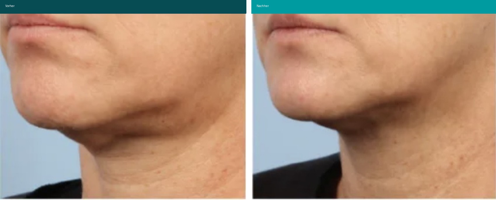 Profound Matrix Vorher Nachher Hanau