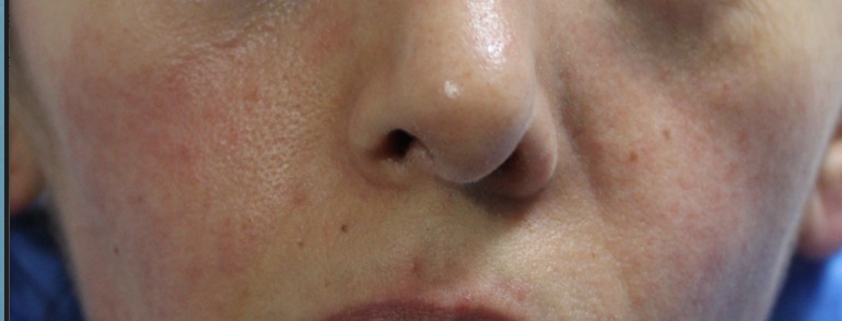 Nachher Rosacea Couperose Hanau