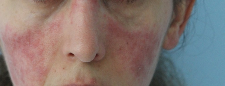Vorher Rosacea Couperose Hanau