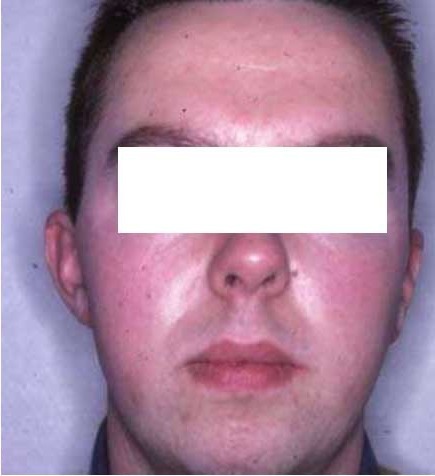 Nachher Rosacea Couperose Hanau