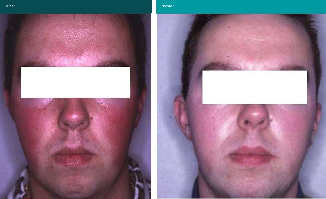 Rosacea Couperose Vorher Nachher Hanau