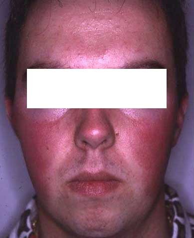 Vorher Rosacea Couperose Hanau