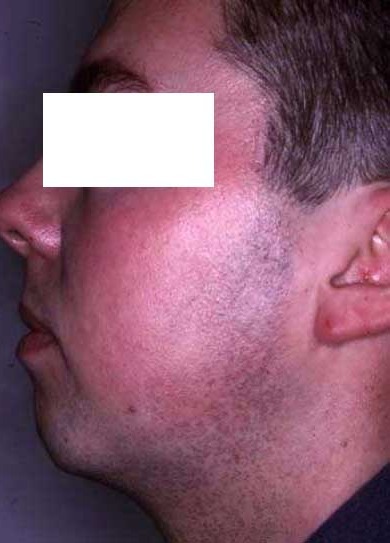 Nachher Rosacea Couperose Hanau