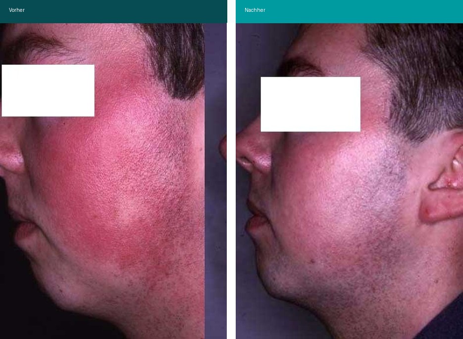 Rosacea Couperose Vorher Nachher Hanau