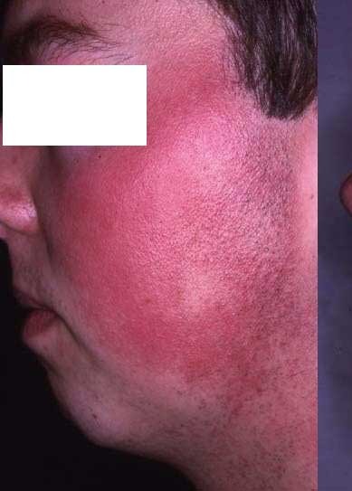 Vorher Rosacea Couperose Hanau