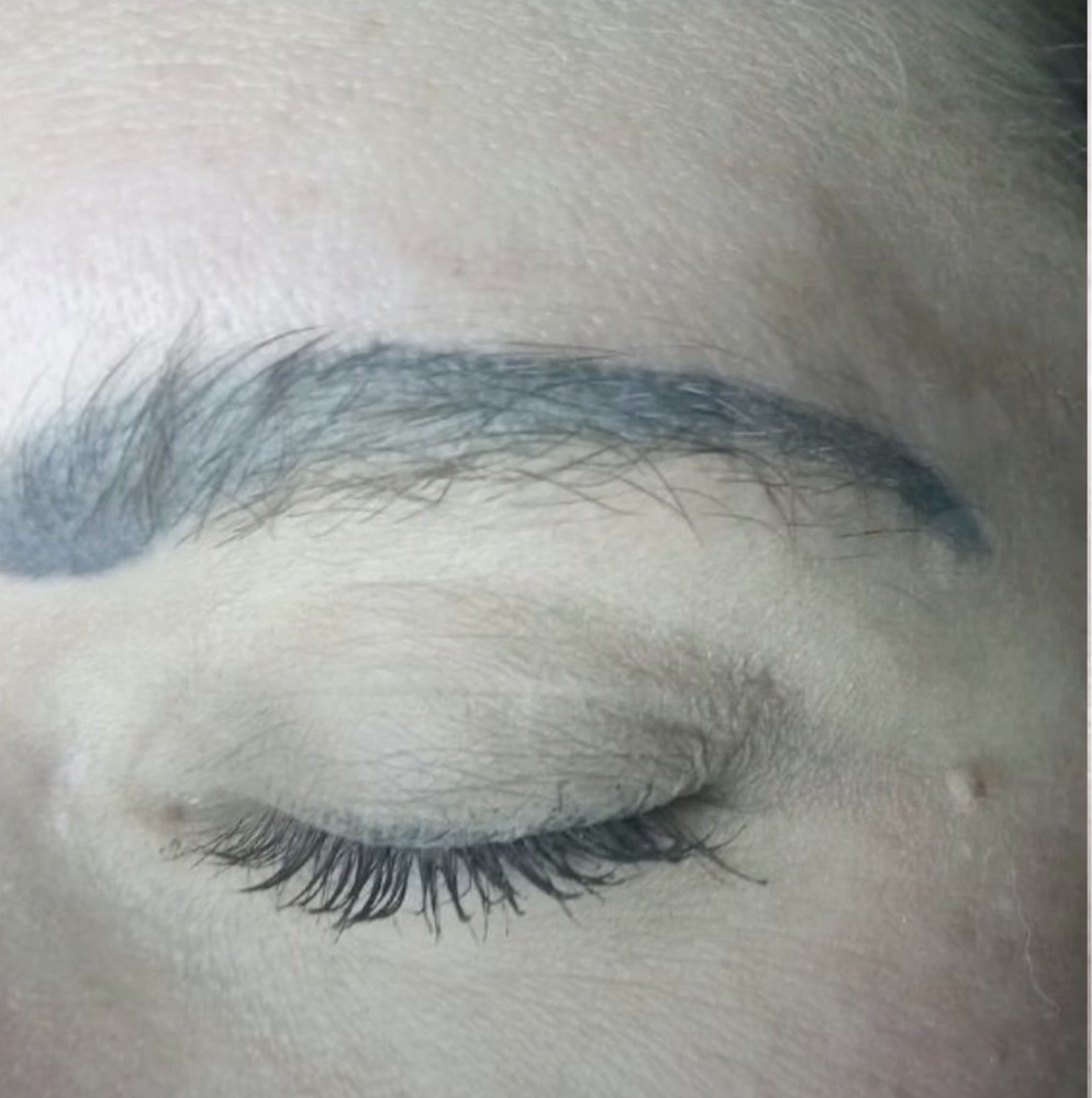Vorher Tattooentfernung Hanau