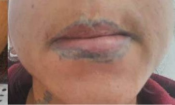 Nachher Tattooentfernung Hanau