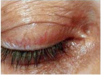 Nachher Xanthelasma Hanau