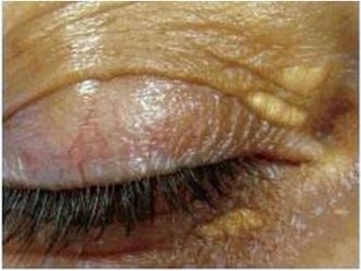 Vorher Xanthelasma Hanau