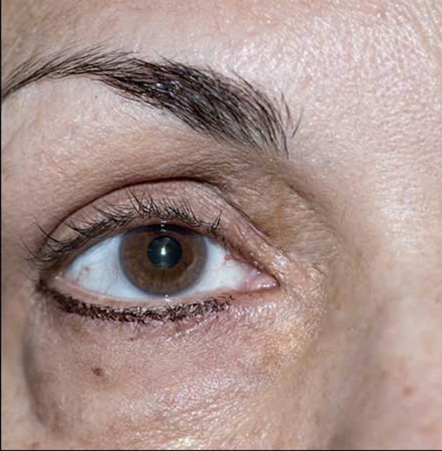 Nachher Xanthelasma Hanau