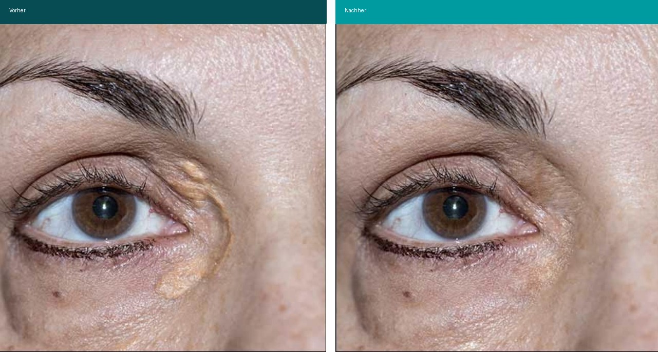 Xanthelasma Vorher Nachher Hanau