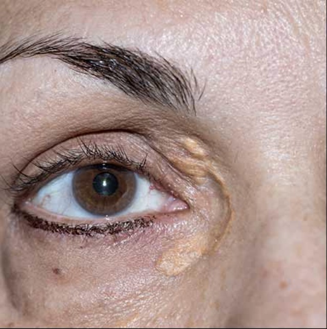 Vorher Xanthelasma Hanau