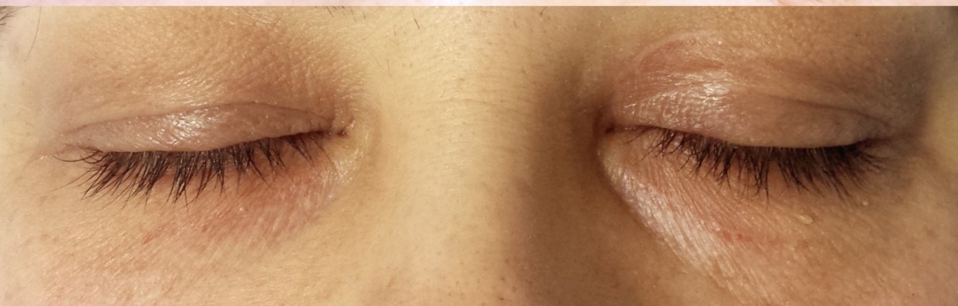 Nachher Xanthelasma Hanau