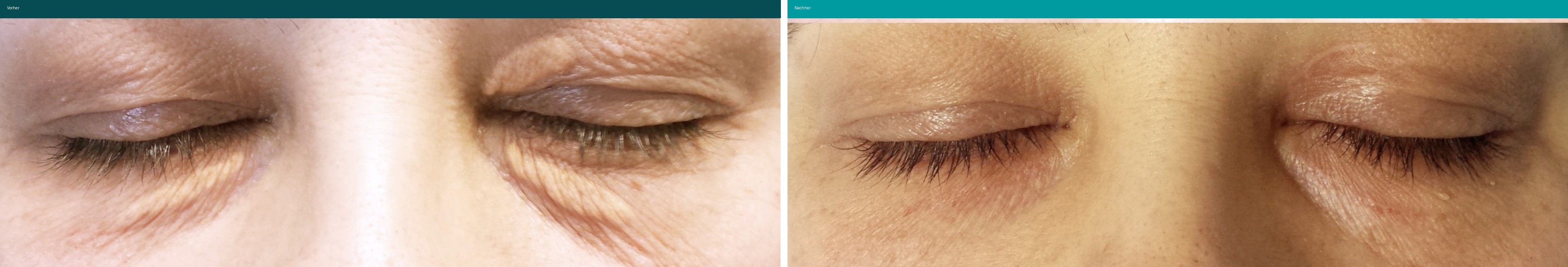 Xanthelasma Vorher Nachher Hanau