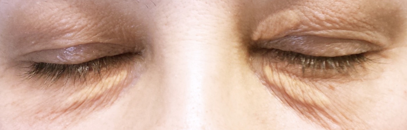 Vorher Xanthelasma Hanau