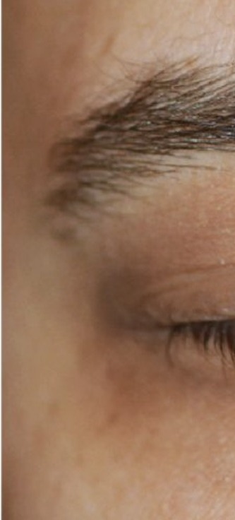Nachher Xanthelasma Hanau