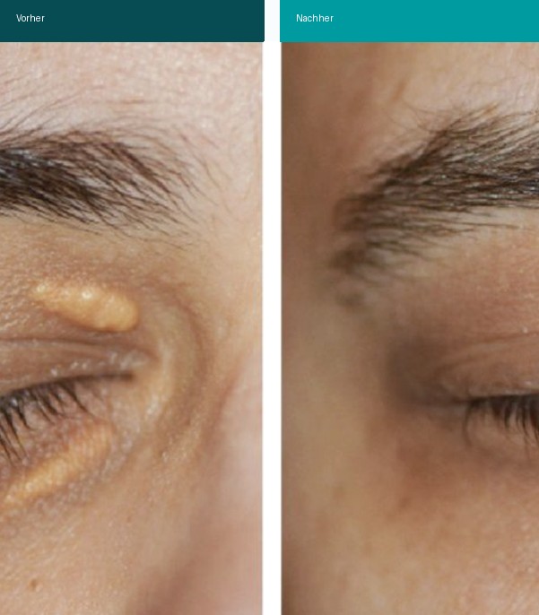 Xanthelasma Vorher Nachher Hanau