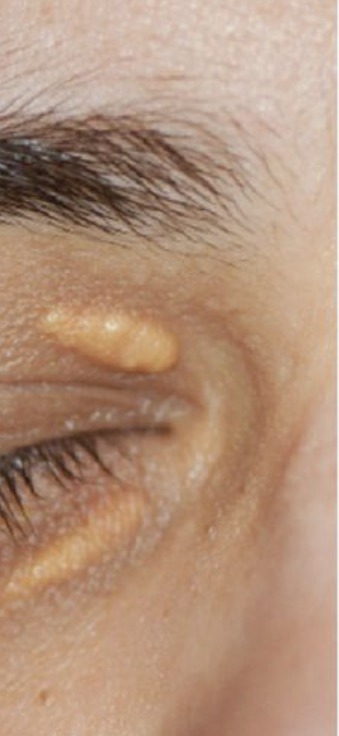 Vorher Xanthelasma Hanau