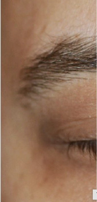 Nachher Xanthelasma Hanau