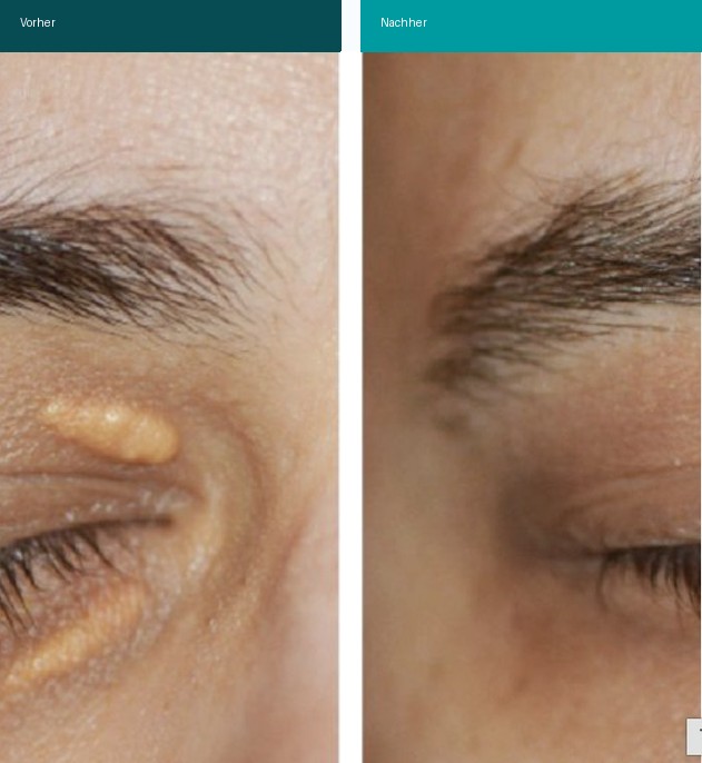 Xanthelasma Vorher Nachher Hanau