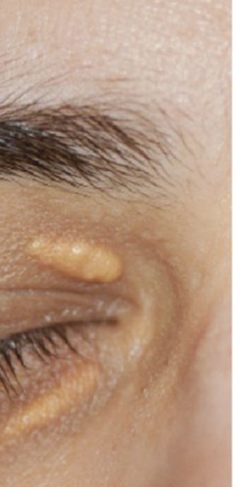 Vorher Xanthelasma Hanau
