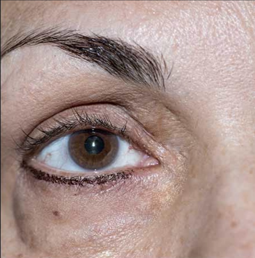Nachher Xanthelasma Hanau