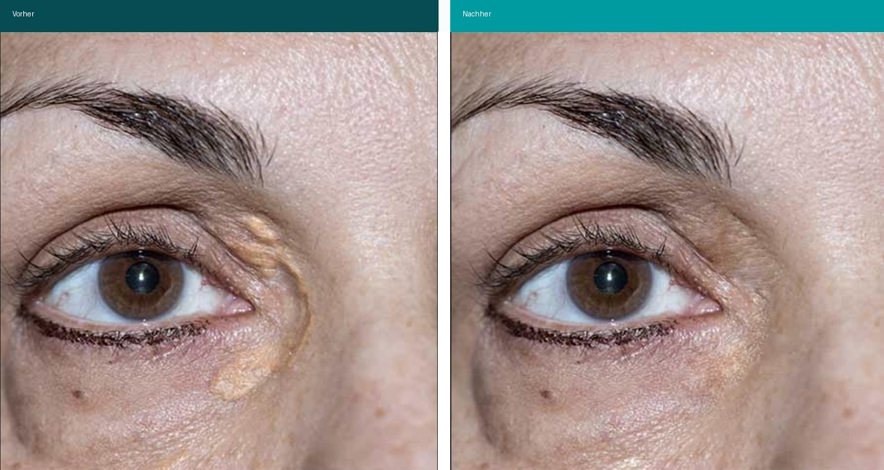 Xanthelasma Vorher Nachher Hanau