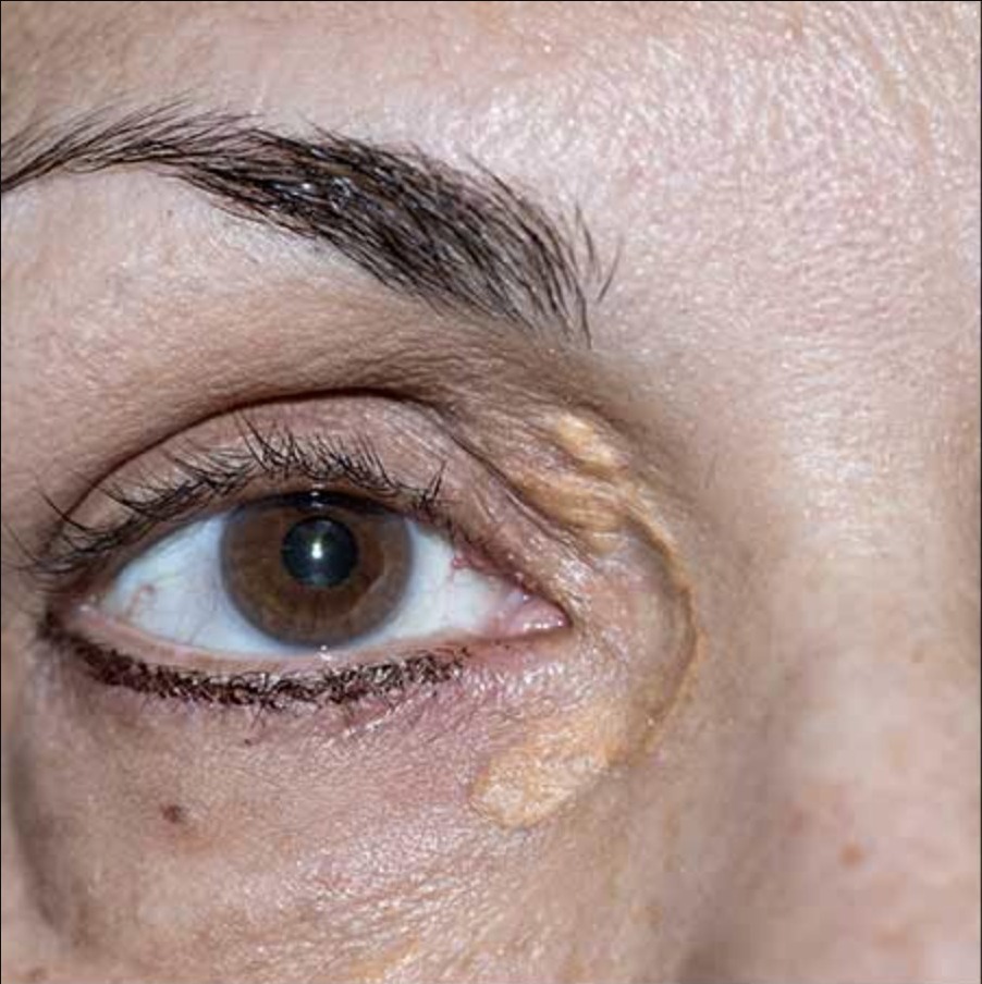 Vorher Xanthelasma Hanau