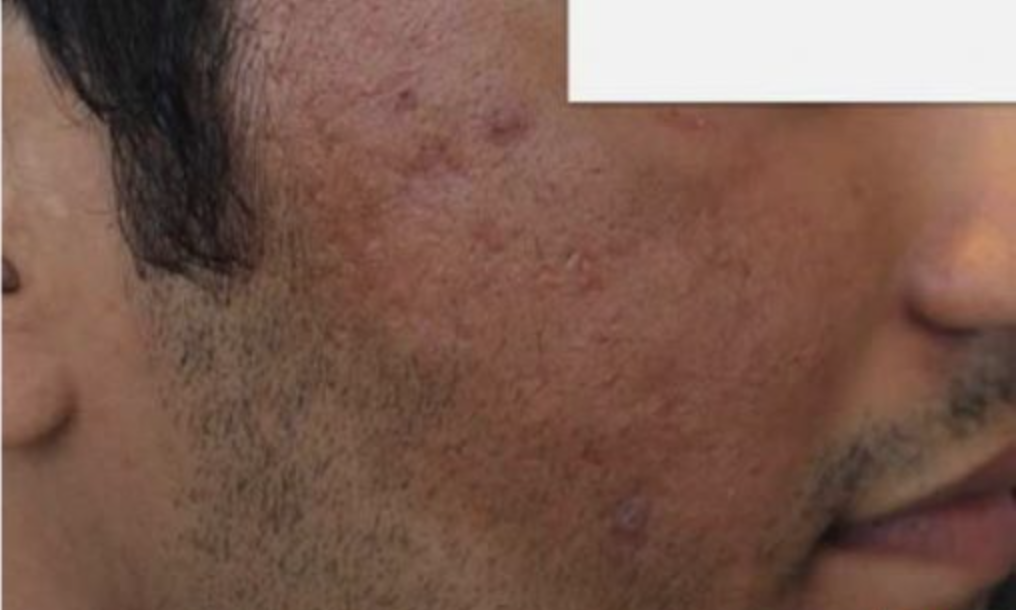 Nach CO2 Laser Narbenbehandlung