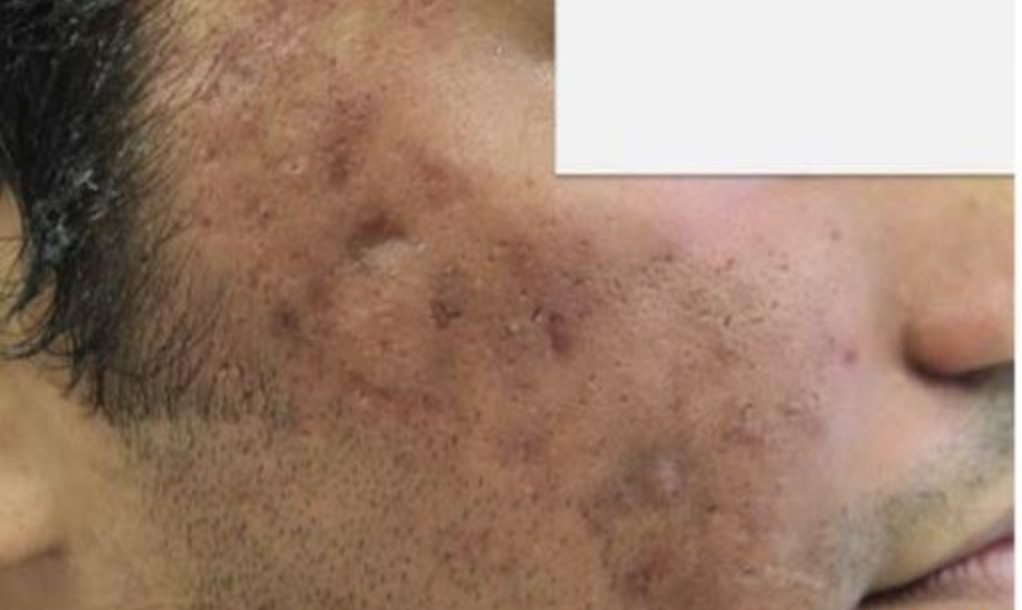 Vor CO2 Laser Narbenbehandlung