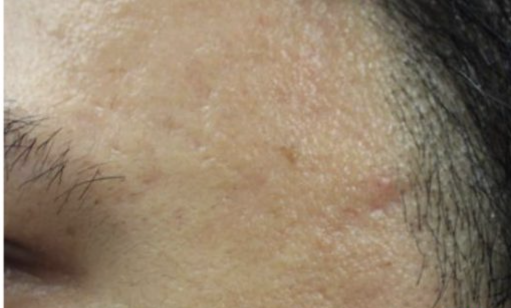 Nach CO2 Laser Resurfacing