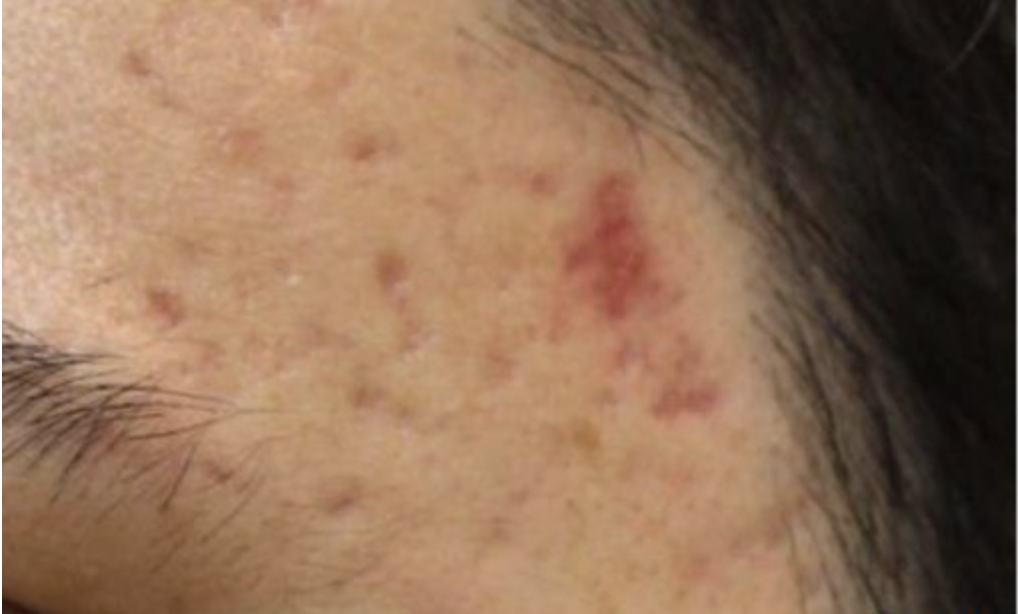 Vor CO2 Laser Resurfacing