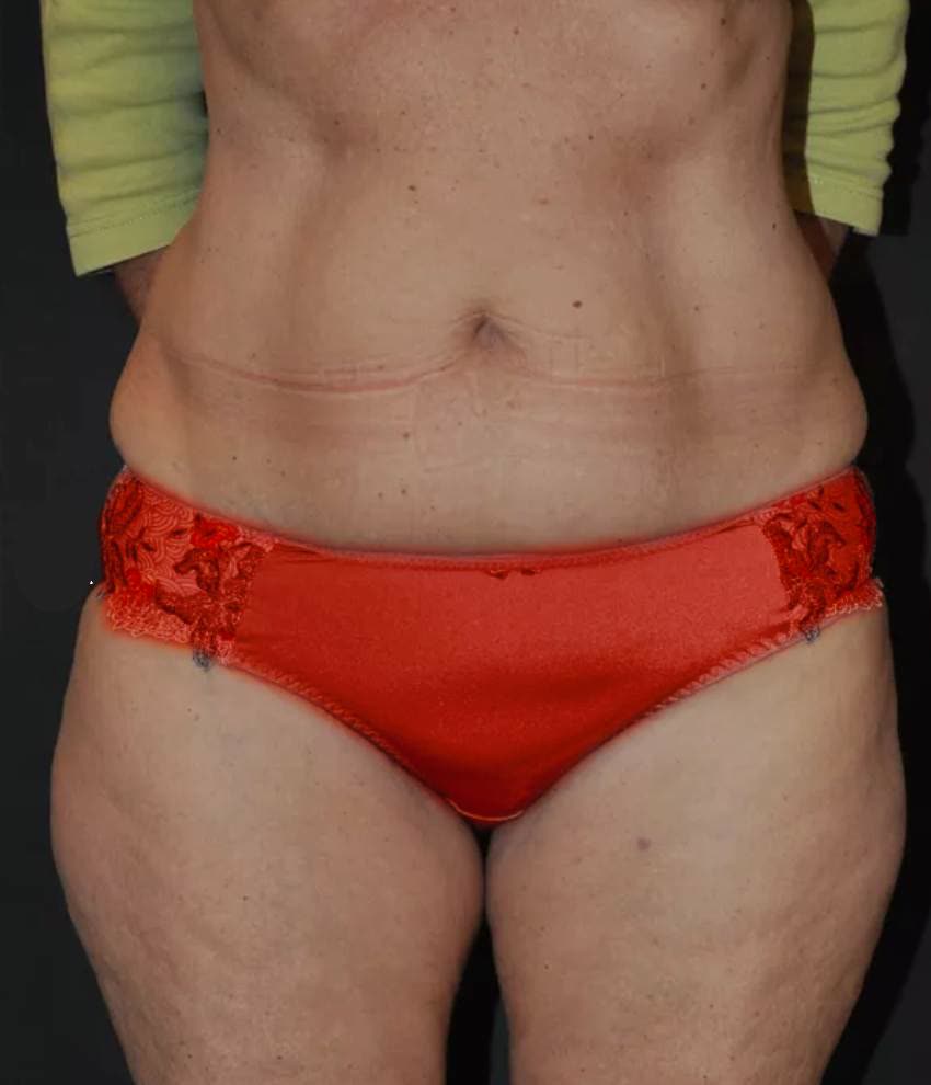 Nach Kryolipolyse Bauch frontal