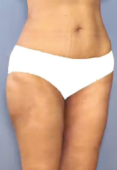 Nach Kryolipolyse Bauch und Kontur
