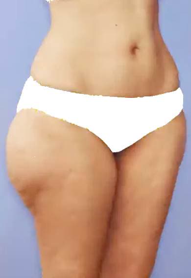 Vor Kryolipolyse Bauch und Kontur