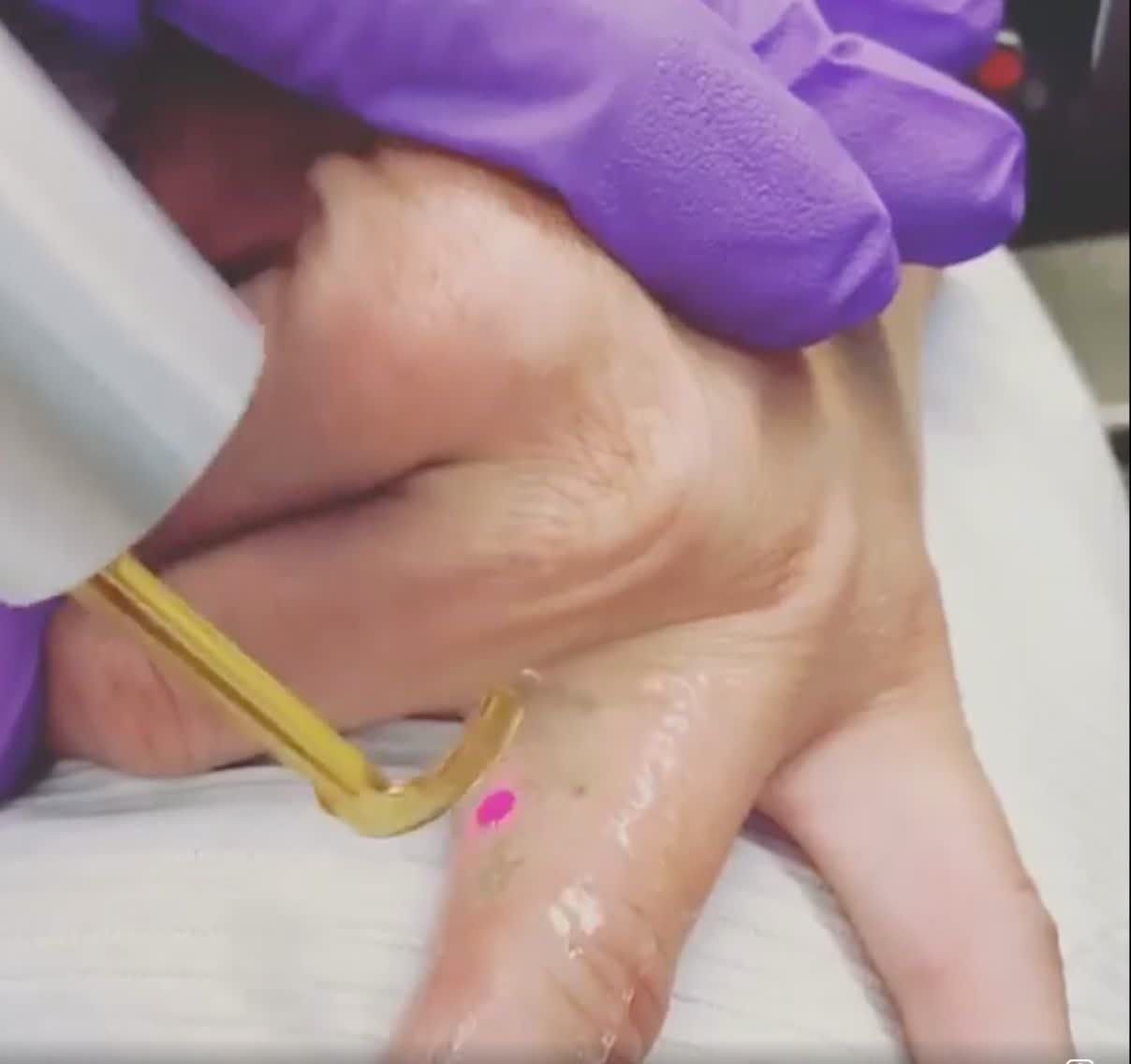 Vor Tattooentfernung an der Hand