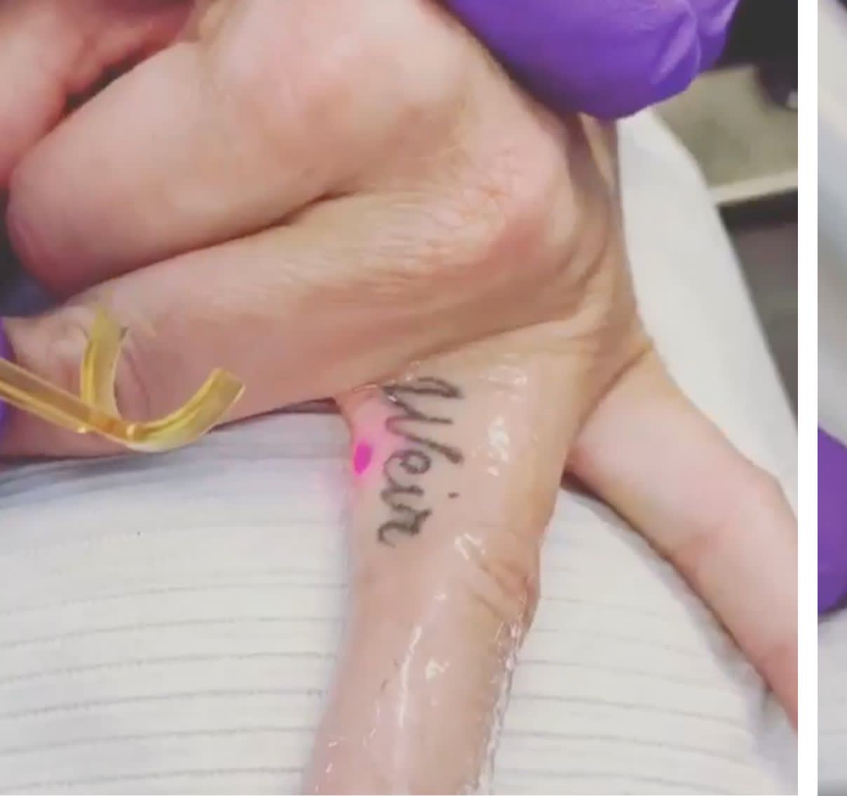 Nach Tattooentfernung an der Hand