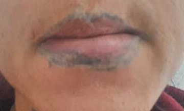 Vor Tattooentfernung im Lippenbereich