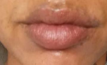 Nach Tattooentfernung im Lippenbereich