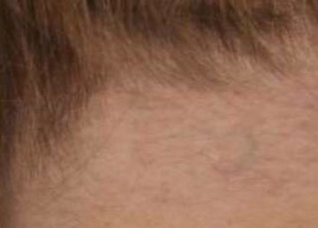 Vor Tattooentfernung an der Stirn