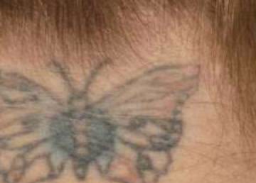 Nach Tattooentfernung an der Stirn