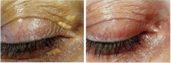 Xanthelasma Entfernung Vorher Nachher Hanau